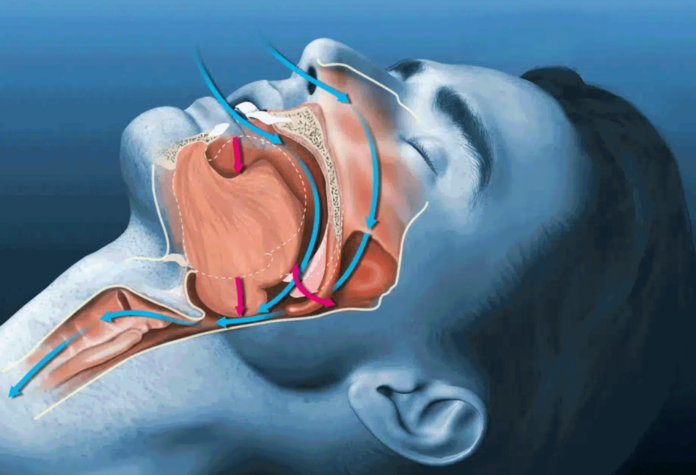 Sleep-Apnea